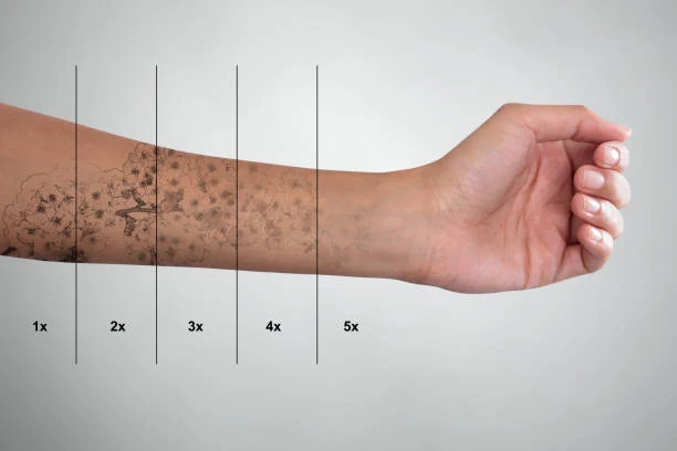 stages of tattoo removal on arm